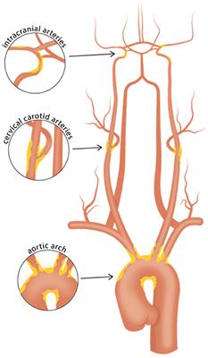 Vessel wall MR imaging of aortic arch, cervical carotid and intracranial arteries in patients with embolic stroke of undetermined source: A narrative review